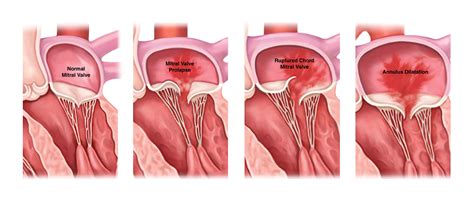 <strong>Mitral valve prolapse</strong> is a condition in which the <strong>valve</strong>’s two flaps turn floppy and fail to close smoothly or evenly. . Mitral valve prolapse covid vaccine exemption
